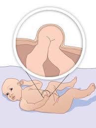 Pediatric Hernia 2.jpg